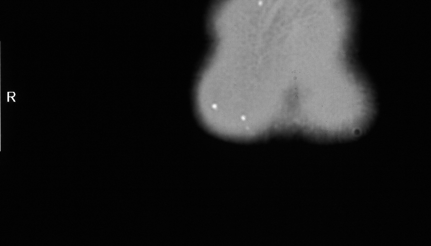 CT scan showing implanted microchips in forehead of a targeted individual
